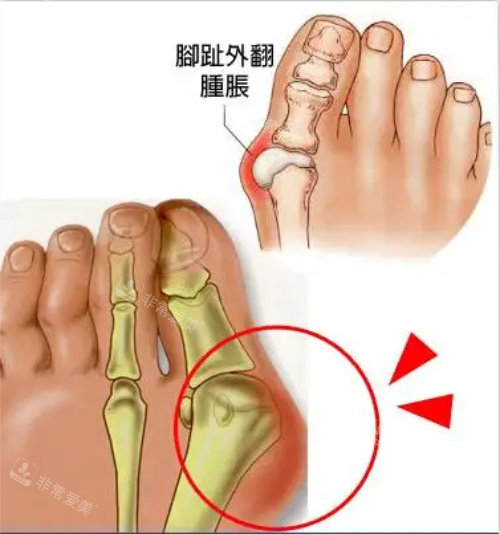 大脚骨手术示意图 大脚骨手术示意图