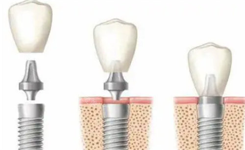 种植牙图片