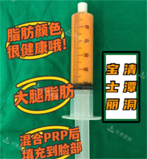 抽取出來(lái)的脂肪示意圖 抽取出來(lái)的脂肪示意圖