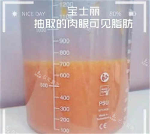 抽取出來(lái)的脂肪肉眼可見 抽取出來(lái)的脂肪肉眼可見