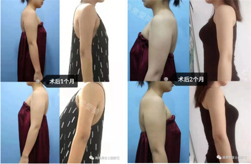 術(shù)后一個(gè)月和兩個(gè)月圖片 術(shù)后一個(gè)月和兩個(gè)月圖片