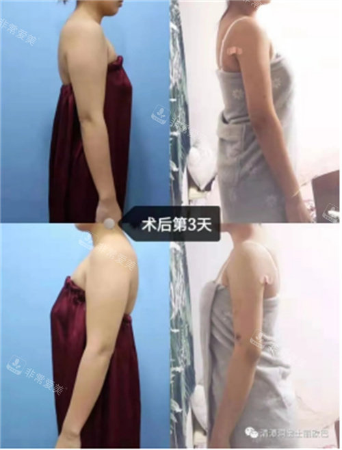 術(shù)后第三天圖 術(shù)后第三天圖