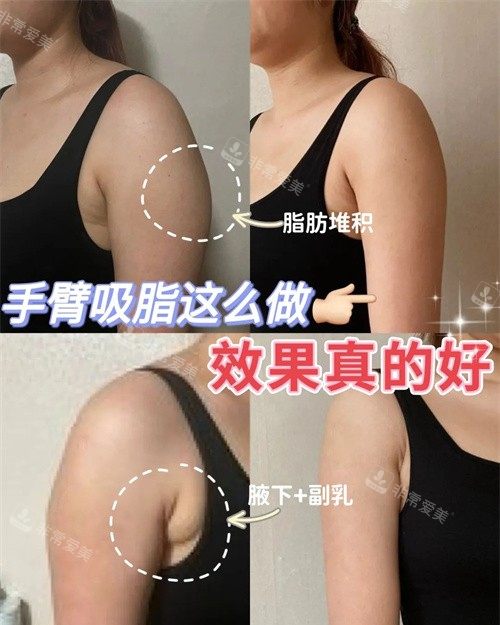 韓國寶士麗整形醫(yī)院手臂吸脂圖 韓國寶士麗整形醫(yī)院手臂吸脂圖