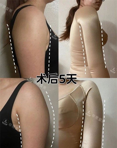 韓國寶士麗整形醫(yī)院術后5天圖 韓國寶士麗整形醫(yī)院術后5天圖