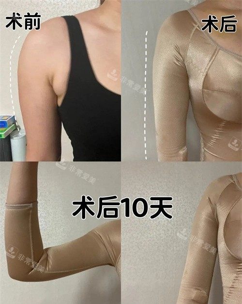 韓國寶士麗整形醫(yī)院術后10天圖 韓國寶士麗整形醫(yī)院術后10天圖