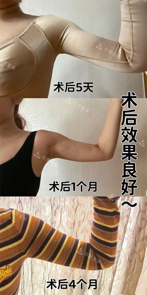 韓國寶士麗整形醫(yī)院術后恢復過程圖 韓國寶士麗整形醫(yī)院術后恢復過程圖