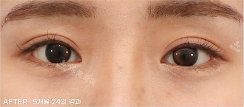双眼皮后照片 双眼皮后照片
