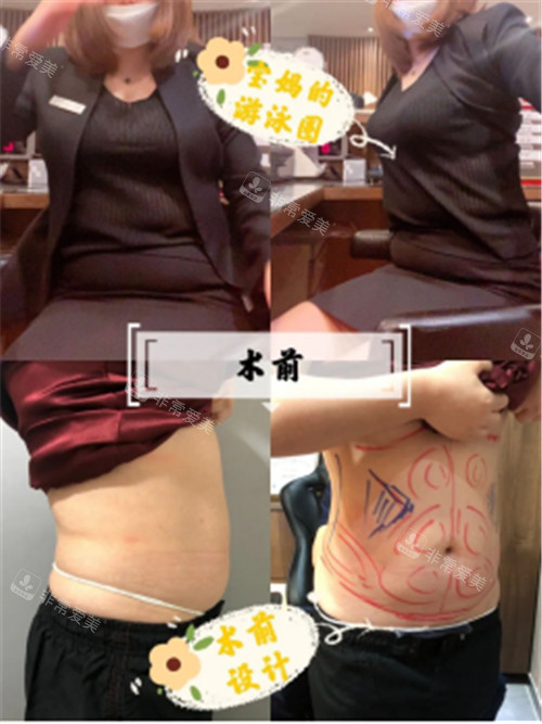 韩国宝士丽医院腰腹吸脂术前图