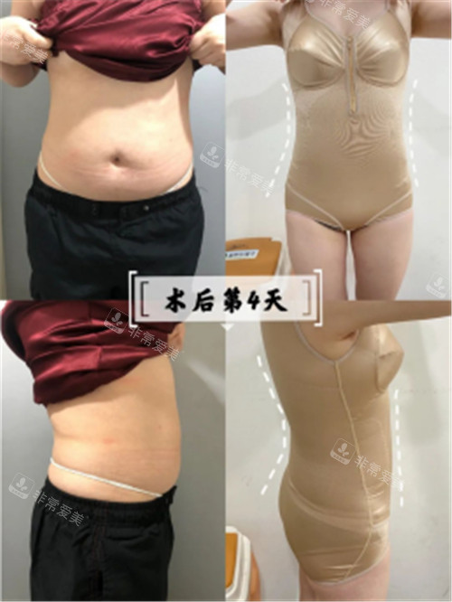 韓國寶士麗醫(yī)院術后4天圖 韓國寶士麗醫(yī)院術后4天圖
