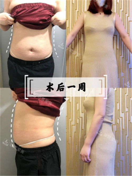 韩国宝士丽医院腰腹吸脂术后一周图