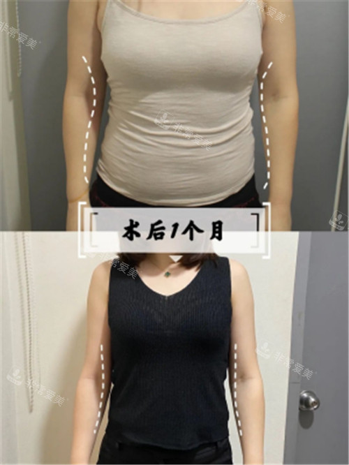 韩国宝士丽医院腰腹吸脂1个月对比