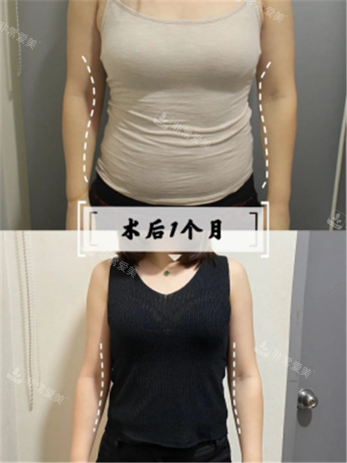 韓國寶士麗醫(yī)院腰腹吸脂1個月對比 韓國寶士麗醫(yī)院腰腹吸脂1個月對比