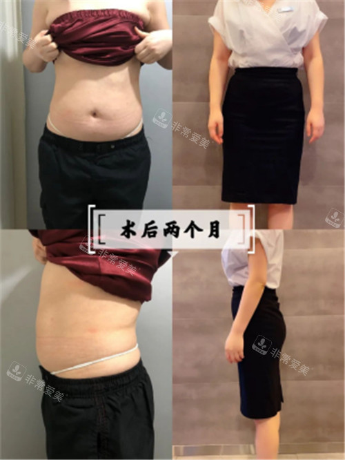 韓國寶士麗醫(yī)院腰腹吸脂2個月對比照 韓國寶士麗醫(yī)院腰腹吸脂2個月對比照
