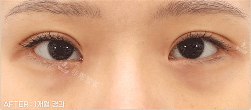 双眼皮后照片 双眼皮后照片