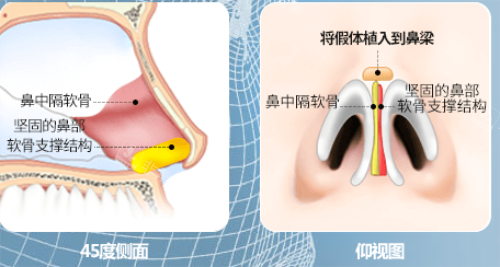 韩国GNG整形医院鼻部整形示意图