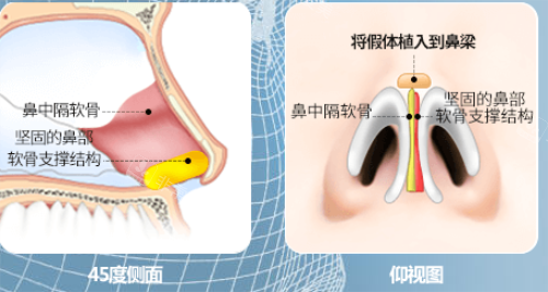 韓國GNG整形醫(yī)院鼻部整形示意圖