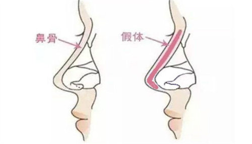 隆鼻假体放置位置展示图