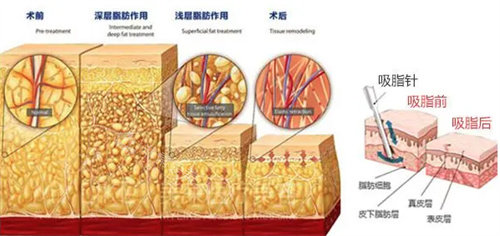 脂肪吸脂圖 脂肪吸脂圖