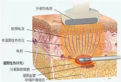 水動力吸脂圖 水動力吸脂圖