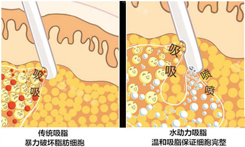水動力吸脂圖 水動力吸脂圖