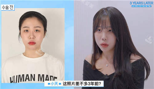 韓國(guó)菲斯萊茵整形面部輪廓整形對(duì)比照 韓國(guó)菲斯萊茵整形面部輪廓整形對(duì)比照