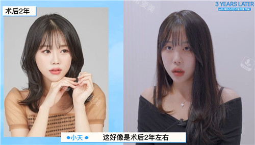 韓國(guó)菲斯萊茵整形面部輪廓整形術(shù)后照片 韓國(guó)菲斯萊茵整形面部輪廓整形術(shù)后照片