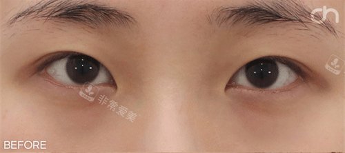 双眼皮前照片 双眼皮前照片