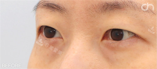 双眼皮前照片 双眼皮前照片
