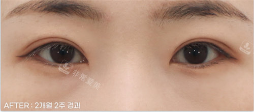 割雙眼皮后照片 割雙眼皮后照片