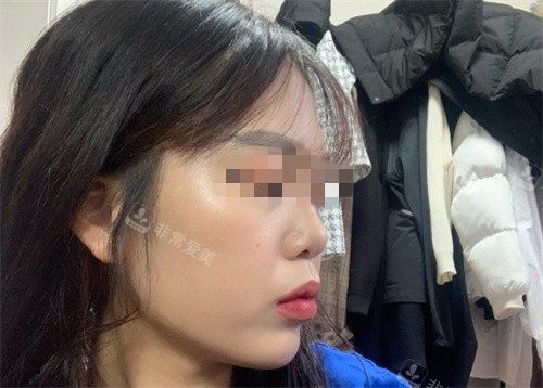 韩国优雅人整形朴哲佑隆鼻案例，做鼻子出名技术很厉害！