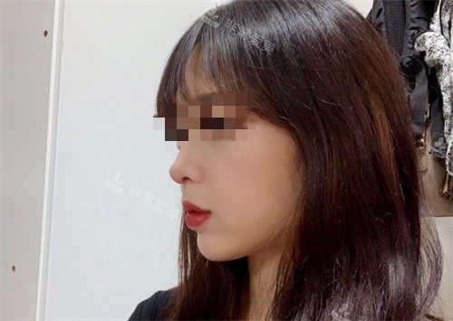 韩国优雅人整形朴哲佑隆鼻日记，做鼻子出名技术很厉害！