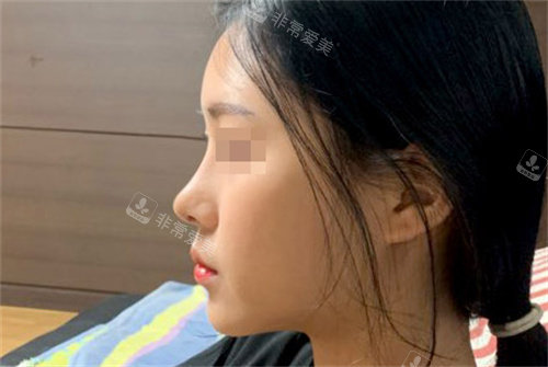 韓國優(yōu)雅人整形醫(yī)院隆鼻后 韓國優(yōu)雅人整形醫(yī)院隆鼻后