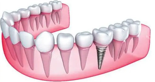 种植牙示意图