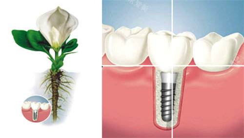 种植牙形象图