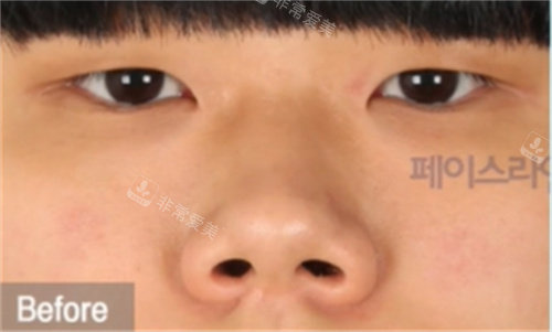 雙眼皮、開眼角和鼻整形前照片