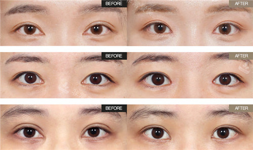 韩国Grida整形外科眼角修复对比图
