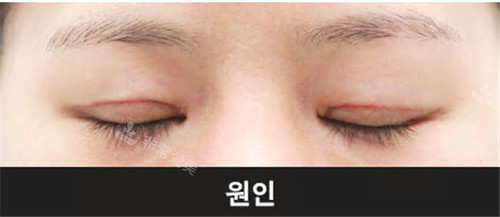 韩国Grida整形外科双眼皮疤痕修复前