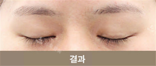 韩国Grida整形外科双眼皮疤痕修复后
