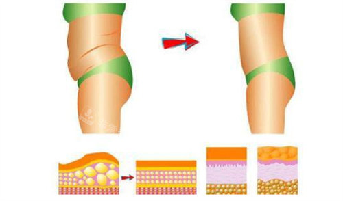 吸脂瘦腰腹前后对比图