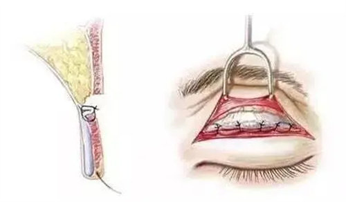 双眼皮剥离缝合动画图