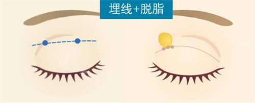 埋线双眼皮手术流程图
