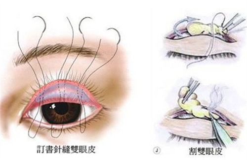 雙眼皮圖 雙眼皮圖