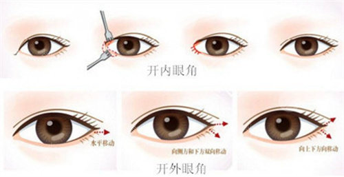 開(kāi)內(nèi)眼角和開(kāi)外眼角的區(qū)別圖 開(kāi)內(nèi)眼角和開(kāi)外眼角的區(qū)別圖