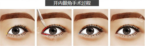 開(kāi)內(nèi)眼角手術(shù)過(guò)程 開(kāi)內(nèi)眼角手術(shù)過(guò)程