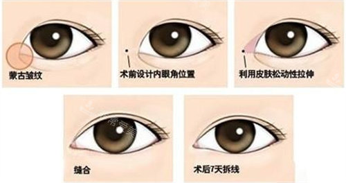 開(kāi)內(nèi)眼角圖 開(kāi)內(nèi)眼角圖