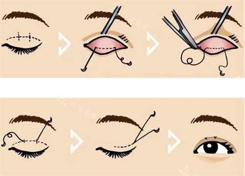 双眼皮手术方法图