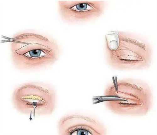 双眼皮过程图