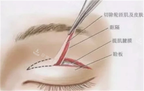 肿眼泡适合做全切双眼皮吗？手术方法具体分析！