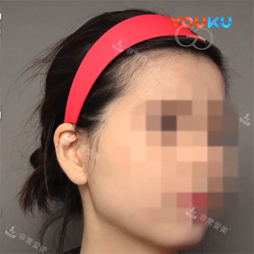 V脸打造后照片 V脸打造后照片