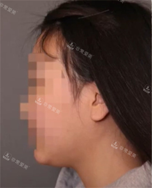 V脸打造前照片 V脸打造前照片